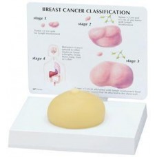 Breast cancer model full size