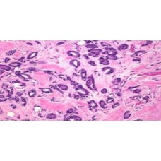 Slide, Microscope, Carcinoma of Breast