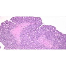 Slide, Microscope, Carcinoma of Ovary