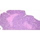 Slide, Microscope, Carcinoma of Ovary